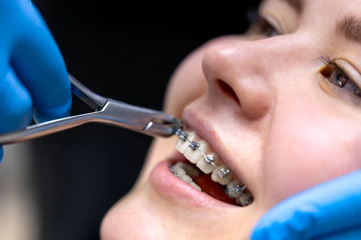 Straightening Teeth Or Conventional Braces