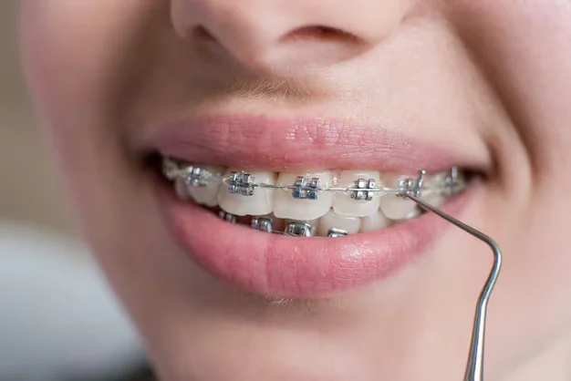 Straightening Teeth (Conventional Braces)