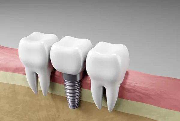 Dental Filling