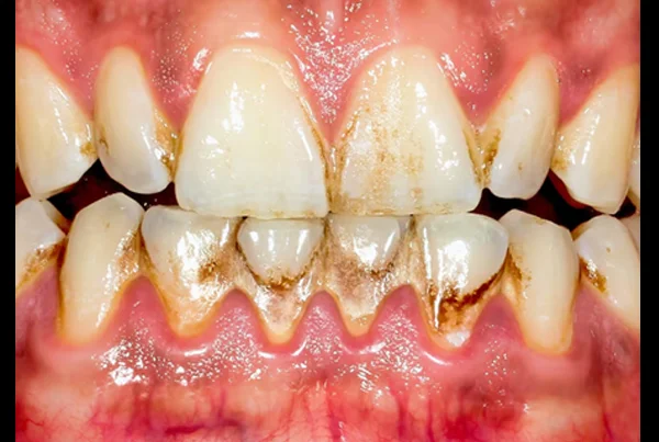 Discolored Tooth Restoration