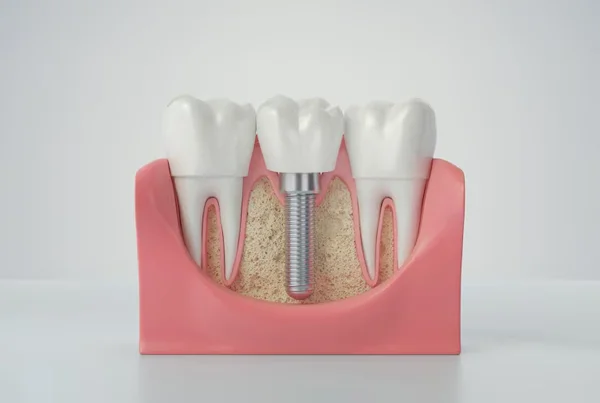 Dental Implant Fixing
