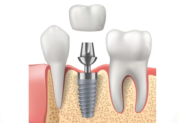 Artificial Teeth Implant
