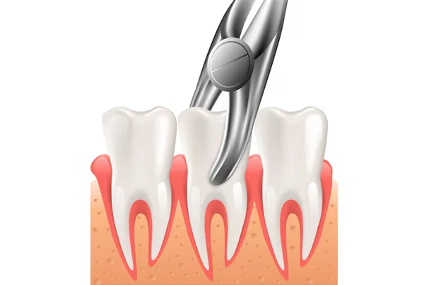 Surgical Tooth Extraction