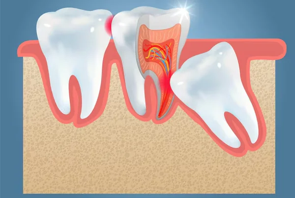 Wisdom Tooth Extraction