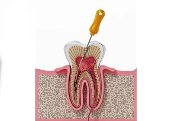 Advanced Root Canal Treatment