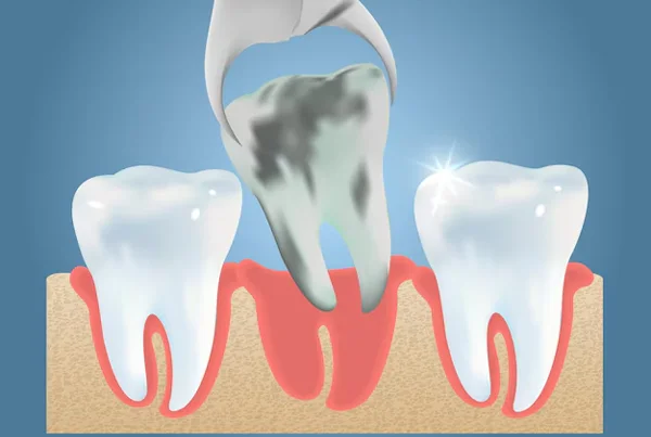 Tooth Extraction