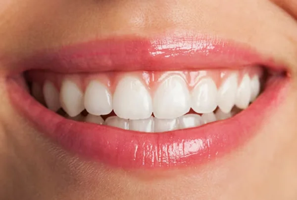 Teeth Reshaping