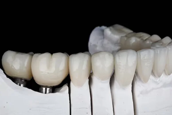 Dental Ceramics