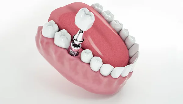 Dental Implant Surgery